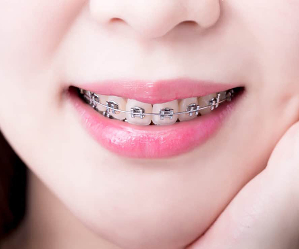 Braces Treatment