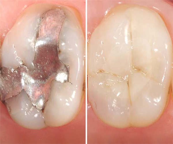 Tooth Colored Filling